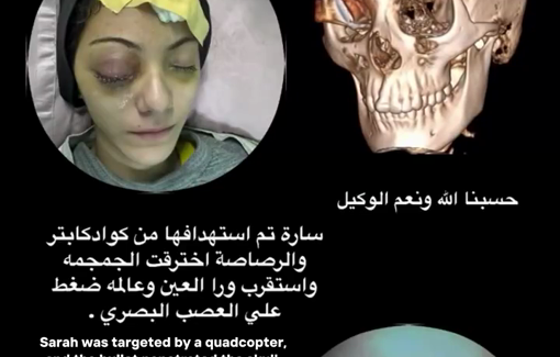 Thumbnail preview image for the video titled: The bullet penetrated the skull, settled behind the eye, and is pressing on the optic nerve